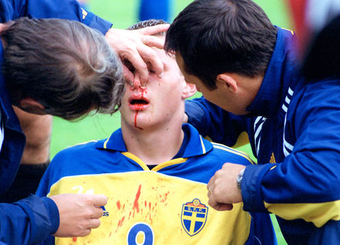 Jon Jönsson, Sverige (Skada, Näsa, Blod)