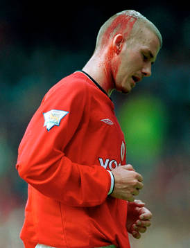 David Beckham, Manchester (Skada, blod)