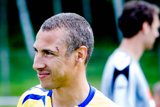 Henrik Larsson med ett ordentligt ärr över ögat