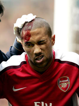 Gael Clichy, Arsenal, huvudskada, skada, blod