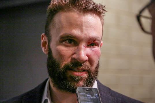 Växjös Josh Hennessy med svullet öga
