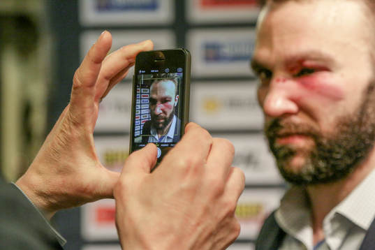 Växjös Josh Hennessy med svullet öga