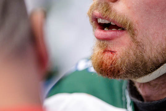Färjestads Alexander Johansson med ett sår på hakan