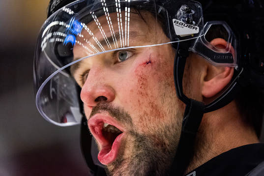 Brynäs Johan Alcén med stygn i ansiktet