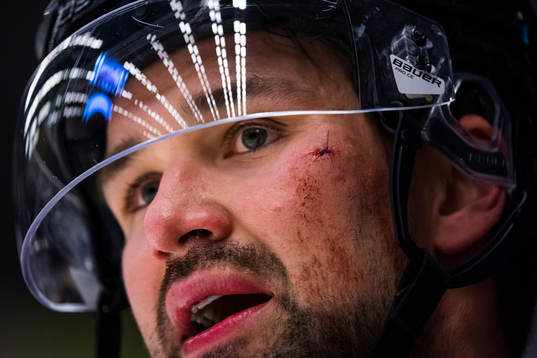 Brynäs Johan Alcén med stygn i ansiktet
