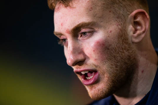 Dejan Kulusevski of Sweden, with a bruise