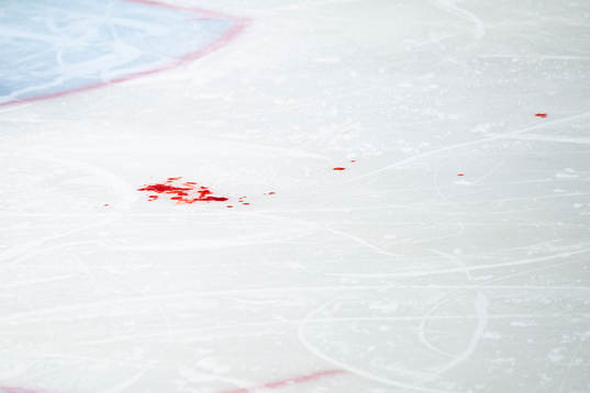 s Emil Andrae ha träffas av en puck i ansiktet